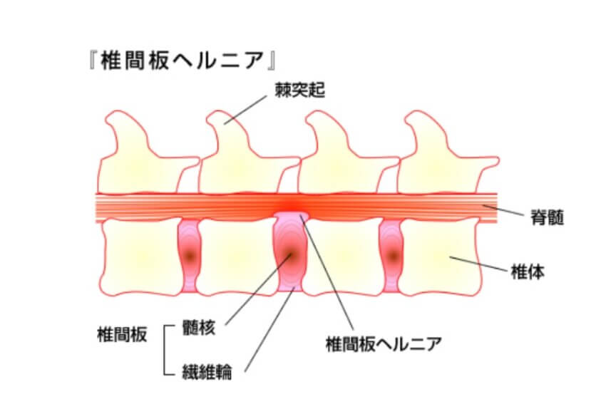 椎間板ヘルニアの構造を示す断面イラスト